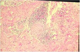 cirugia_pancreatitis_cronica/pancreatitis_cronica cirugia_pancreatitis_cronica/pancreatitis_cronica