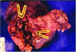 cirugia_pancreatitis_cronica/pieza_pancreotomia cirugia_pancreatitis_cronica/pieza_pancreotomia