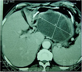 cirugia_pancreatitis_cronica/pseudoquiste_pancreatico