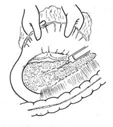 cirugia_pancreatitis_cronica/reconocimiento_conducto_wirsung