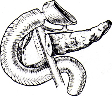 cirugia_pancreatitis_cronica/reseccion_cabeza_pancreas