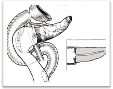 cirugia_pancreatitis_cronica/restauracion_drenaje_pancreatoenterico