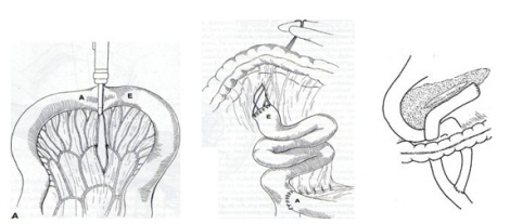 cirugia_pancreatitis_cronica/segmentoY_incision_ligacion