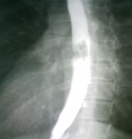 cuerpo_introducido_esofago/rx_lateral cuerpo_introducido_esofago/rx_lateral