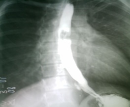 cuerpo_introducido_esofago/rx_posteroanterior cuerpo_introducido_esofago/rx_posteroanterior