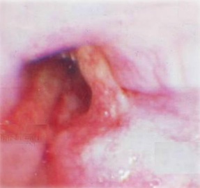 cuerpo_introducido_esofago/vista_endoscopica