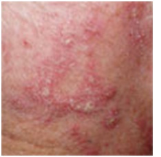 dermatologia_medicina_familia/dermatitis_seborreica dermatologia_medicina_familia/dermatitis_seborreica