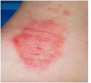 dermatologia_medicina_familia/imagen_eczema