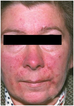 dermatologia_medicina_familia/rosacea_hombre dermatologia_medicina_familia/rosacea_hombre