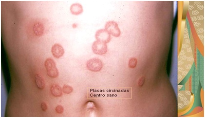 dermatologia_medicina_familia/tiña_corporis_herpes_circinado dermatologia_medicina_familia/tiña_corporis_herpes_circinado