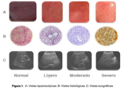 ecografia_hepatopatia_grasa/vistas_laparoscopica_histologica_ecografica