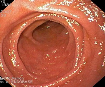 endoscopia_enfermedad_celiaca/intestino_pliegues_Kerckring