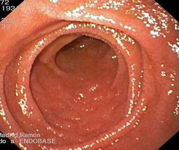 endoscopia_enfermedad_celiaca/intestino_pliegues_Kerckring endoscopia_enfermedad_celiaca/intestino_pliegues_Kerckring