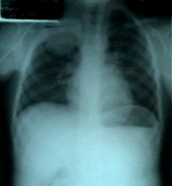 hamartoma_pared_toracica/rx_frente_lesion_campo_derecho hamartoma_pared_toracica/rx_frente_lesion_campo_derecho