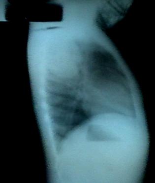 hamartoma_pared_toracica/rx_perfil_lesion_campo_derecho hamartoma_pared_toracica/rx_perfil_lesion_campo_derecho