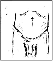 hernia_herniorrafia_cirugia/variante_tecnica_1