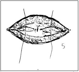 hernia_herniorrafia_cirugia/variante_tecnica_5