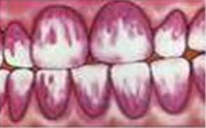 higiene_oral_escolares/eritrosina_aplicada higiene_oral_escolares/eritrosina_aplicada
