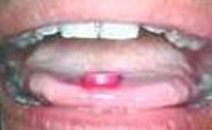 higiene_oral_escolares/eritrosina_pastilla