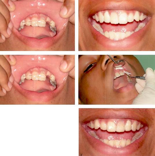 homeopatia_traumatismo_dentario/fractura_dental_ferula