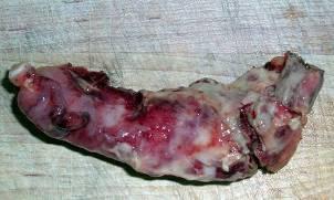 incision_apendicitis_aguda/apendicectomia incision_apendicitis_aguda/apendicectomia