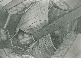 incision_apendicitis_aguda/figura_11 incision_apendicitis_aguda/figura_11
