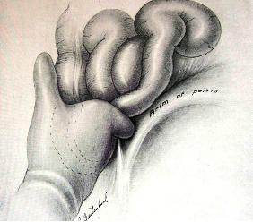 incision_apendicitis_aguda/figura_12