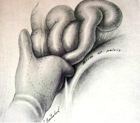 incision_apendicitis_aguda/figura_12 incision_apendicitis_aguda/figura_12