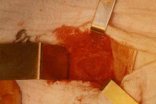 incision_apendicitis_aguda/figura_2 incision_apendicitis_aguda/figura_2