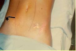 incision_apendicitis_aguda/figura_4 incision_apendicitis_aguda/figura_4