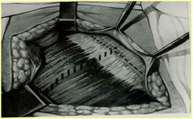 incision_apendicitis_aguda/figura_5 incision_apendicitis_aguda/figura_5
