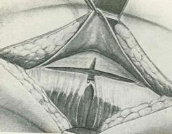 incision_apendicitis_aguda/figura_8 incision_apendicitis_aguda/figura_8