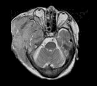 linfoma_no_Hodgkin/RMN_tumor_craneal