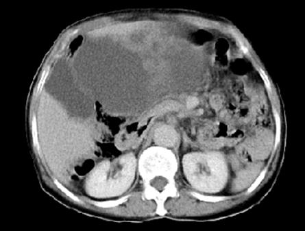 mesotelioma_peritoneal_caso_clinico/figura_2