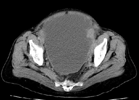 mesotelioma_peritoneal_caso_clinico/figura_3