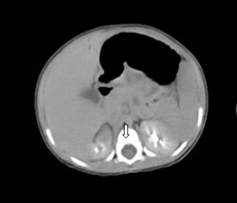 neuroblastoma_caso_clinico/TAC_suprarrenal_der