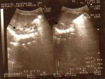neuroblastoma_caso_clinico/tumoracion_SR_der