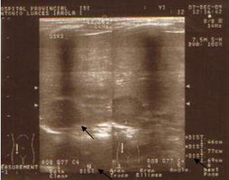 neuroblastoma_caso_clinico/tumoracion_SR_der2