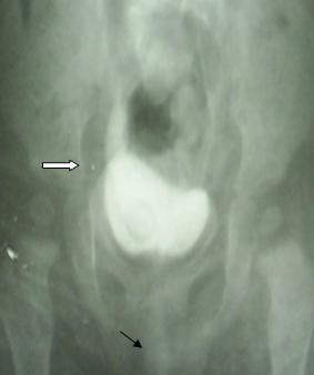 neuroblastoma_caso_clinico/urograma_desdendente_UCD
