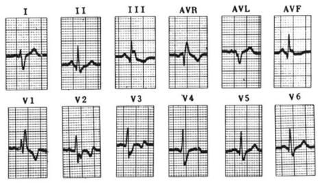 patologia_cardiovascular_deportistas/ecg_BCRD