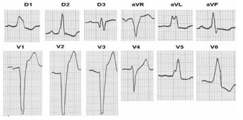 patologia_cardiovascular_deportistas/ecg_BCRI