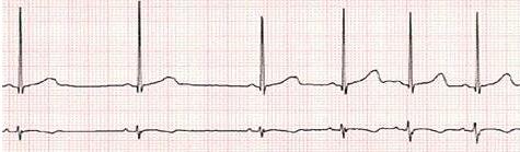 patologia_cardiovascular_deportistas/ecg_arritmia_sinusal