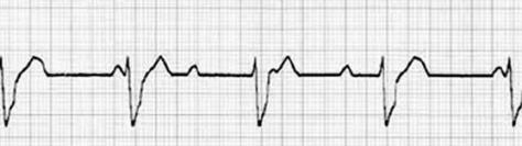 patologia_cardiovascular_deportistas/ecg_bav_III