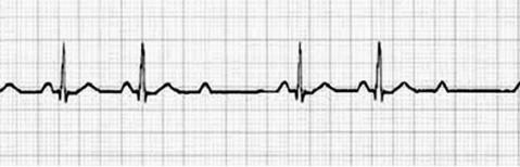 patologia_cardiovascular_deportistas/ecg_bav_mobitz_II