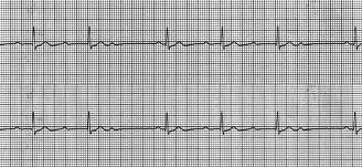 patologia_cardiovascular_deportistas/ecg_bav_wenckebach