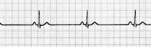 patologia_cardiovascular_deportistas/ecg_bradicardia_sinusal