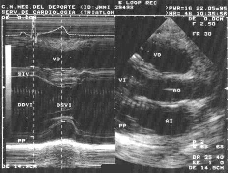 patologia_cardiovascular_deportistas/ecocardiograma_corazon_atleta