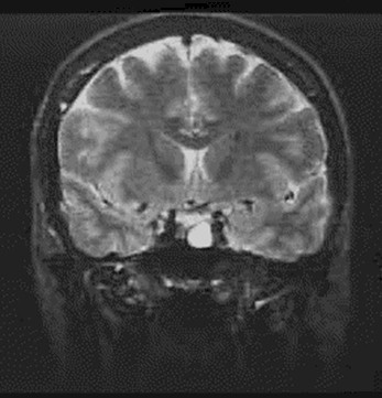 prolactinoma_caso_clinico/RMN_silla_turca_adenoma