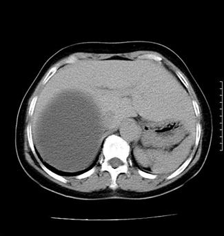 quiste_retroperitoneal_caso/figura_2_1