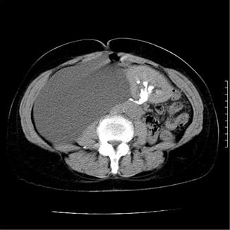 quiste_retroperitoneal_caso/figura_2_2